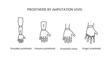 das Niveau von Amputation von das Arm. Prothese Vektor Linie Symbol