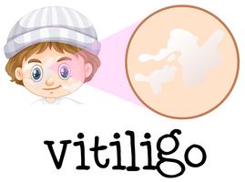 En ung pojke som har vitiligo vektor