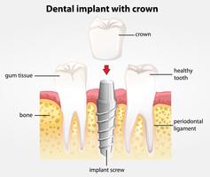 Zahnimplantat mit Krone vektor