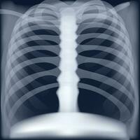 Röntgen medizinisch Bild von Truhe vektor