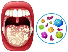 Eine menschliche Mund-Virus-Infektion vektor