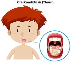 Ein Junge mit oraler Candidiasis vektor