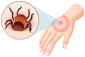 Tick Bite menschliche Hand vektor