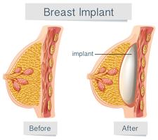 Menschliche Anatomie des Brustimplantats vektor