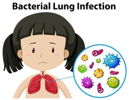 En vektor av bakteriell lunginfektion