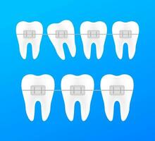 Korrektur von Zähne mit kieferorthopädisch Zahnspange. Stufen von Zähne Ausrichtung. Dental Klinik Dienstleistungen. Vektor Illustration