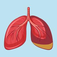 Menschliche Lunge mit Pleuramesotheliom vektor
