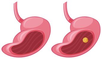 Mänsklig mage och cancer vektor