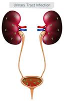 Urinvägsinfektion på vit bakgrund vektor