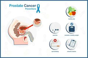 vektor medicinsk illustration i platt stil, prostata cancer koncept.förebyggande av prostata cancer inkluderar friska kost, motion, underhåll en friska vikt, konsultera en läkare och sluta rökning.