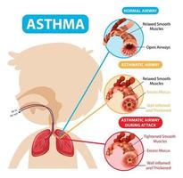 Asthmadiagramm mit normalen Atemwegen und asthmatischen Atemwegen vektor