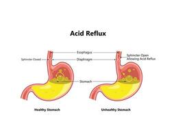 återflöde eller gastroesofageal reflux, halsbränna. mage sjukdom, mage problem sjukdom begrepp. vektor teckning