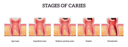 Stadien der Zahnzerstörung vektor