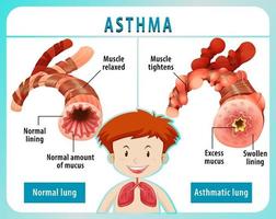 Asthmadiagramm mit normaler Lunge und asthmatischer Lunge vektor