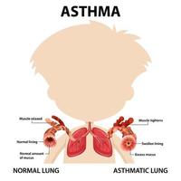 astma diagram med normal lunga och astmatisk lunga vektor