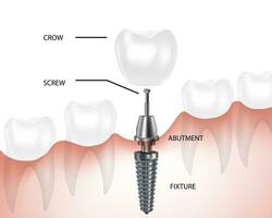 Dental implantieren Komponente Teile, Zahn Prothese Komponenten, Vektor. vektor