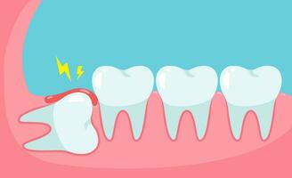 betroffen Weisheit Zahn Ursache Schmerzen im das Mund.Zahnmedizin Pflege Konzept vektor