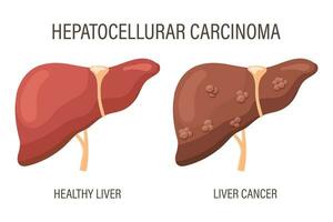 hepatocellulär carcinom, lever sjukdomar. friska lever och lever cancer. medicinsk infographic baner. vektor