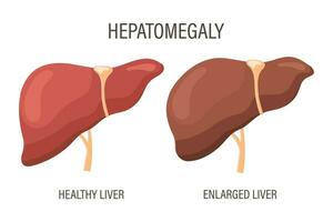 Hepatomegalie, Leber Krankheiten. gesund Leber und vergrößert Leber. medizinisch Infografik Banner. Vektor