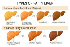 typer av fet lever. mänsklig lever sjukdomar. alkoholhaltig och alkoholfri fet lever. hepatit, lever cirros, fibros, steatos. medicinsk infographic baner. vektor