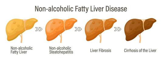 typer av fet lever. mänsklig lever sjukdomar. alkoholfri fet lever sjukdom. hepatit, lever cirros, fibros, steatos. medicinsk infographic baner. vektor