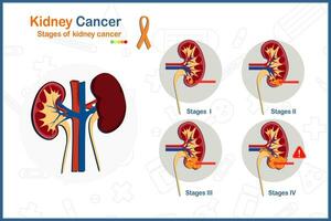 medicinsk vektor illustration begrepp i platt stil av njure cancer. 4 etapper av njure cancer och njure tumör illustration.isolated på vit bakgrund.