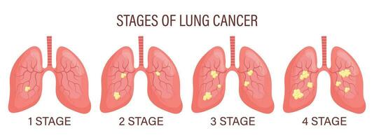stadier av lunga cancer, lunga sjukdom. medicinsk infographic baner, illustration, vektor
