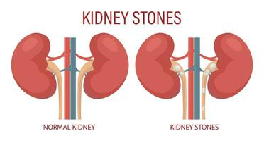 njure stenar. mänsklig njure sjukdom. medicinsk infographic baner, illustration, vektor