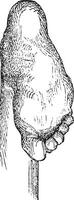 Klumpfuß oder angeboren Spitzfüße Equinovarus ctev, Jahrgang Engra vektor