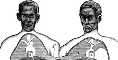 siamese tvillingar. v. vena cava. f. övre begränsa av de allmänning axel, årgång gravyr. vektor