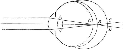 das Position von das Retina im in der Nähe von und weit Sicht, Jahrgang Illustration. vektor