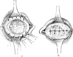 Entfernung von das anterior Segment von das Auge mit gesamt Staphylom vektor