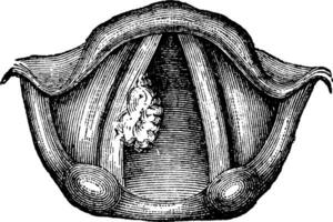 einsam Papillom von das Larynx, Jahrgang Gravur vektor