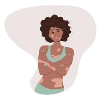 schöne afroamerikanische Frau mit Vitiligo.
