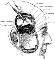 Einschnitt von das Kopf zeigen Gasser Ganglion, Jahrgang Illustration vektor