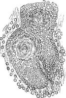 Sektion von Plattenepithel Epitheliom, Jahrgang Gravur. vektor