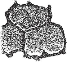 tre alveolerna fylld med fibrinösa exsudat, årgång gravyr. vektor