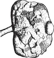 Niere zeigen fortgeschritten chronisch interstitial Nephritis, Jahrgang Gravur. vektor