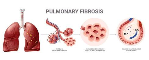 Lungen Fibrose Infografik. Vektor Illustration isoliert auf Weiß Hintergrund