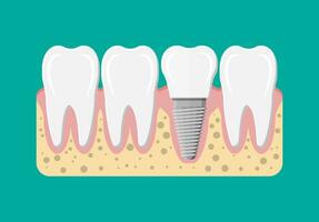 tand restaurering. dental implantera. dental proteser. artificiell tänder med stål stift. oral vård, stomatologi och tandvård. vektor illustration i platt stil