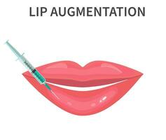 Lippen Injektion isoliert Über Weiß Hintergrund. Lippe Augmentation. Vektor Illustration im eben Stil