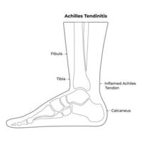 Achilles Tendinitis Wissenschaft Design Vektor Illustration