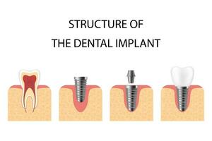 dental implantera. skruva protes, ortodontisk dental implantation vektor