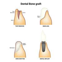 Dental Knochen Transplantat Wissenschaft Design Vektor Illustration