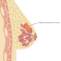 Fibroadenomatose. medizinisch Infografik Kreuz Sektion von weiblich Brust. Information Karte Klumpen. Anatomie von Frau Truhe mit Infektion. Entzündung von Brust Drüse. Schmerz. Vektor Illustration.