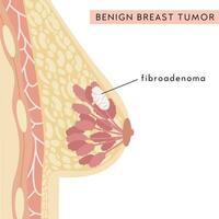 gutartig Brust Tumor. medizinisch Infografik Kreuz Sektion von weiblich Brust. Information Karte. Anatomie von Frau Truhe mit Infektion. Entzündung von Brust Drüse. Schmerz. Vektor Illustration.