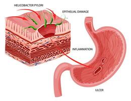 Bauch Geschwür verursacht durch Helicobacter Pylori Infektion. vektor