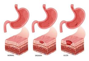 Bauch Erosion und Geschwür Entwicklung Illustration vektor