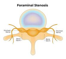 foraminal Stenose Wissenschaft Design Vektor Illustration