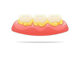 plack på tänder och tandkött. dental hälsa begrepp. vektor illustration.